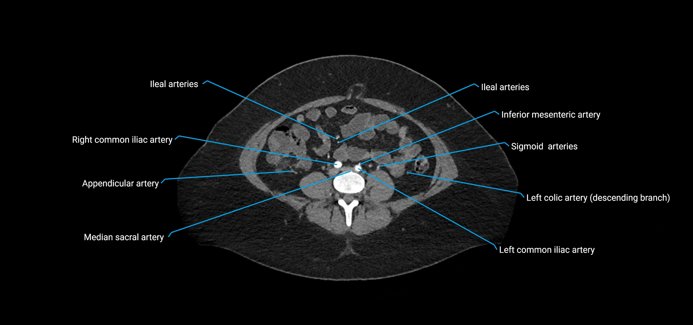 CTA abdomen axial cross sectional anatomy labelled image_146 (2).webp